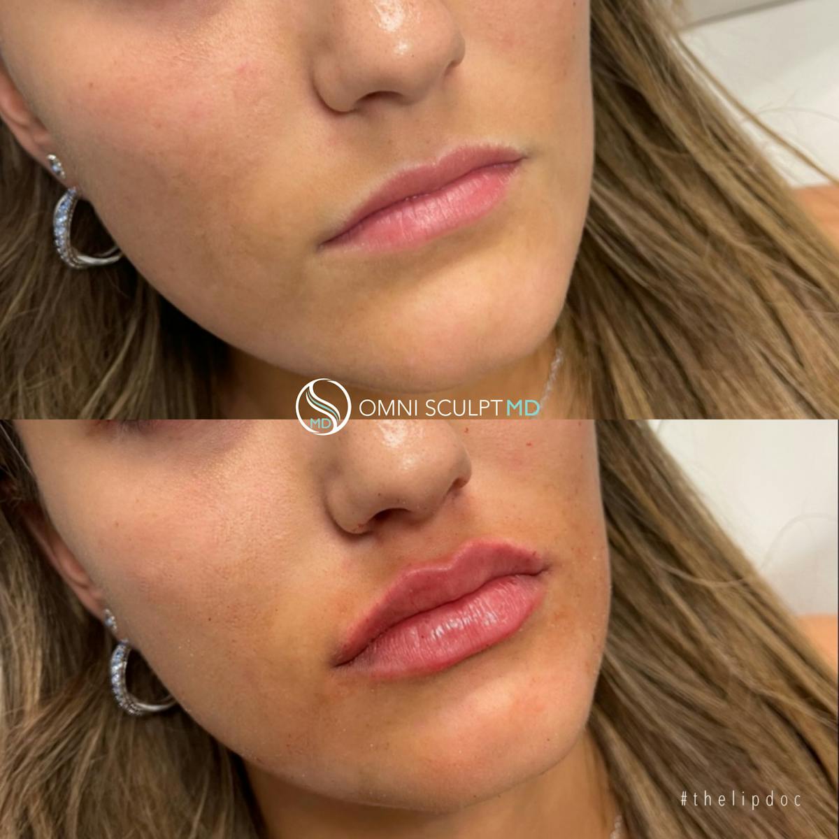 Lips Before & After Gallery - Patient 822743 - Image 3
