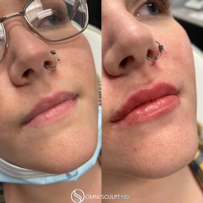 Lips Before & After Gallery - Patient 235036 - Image 1