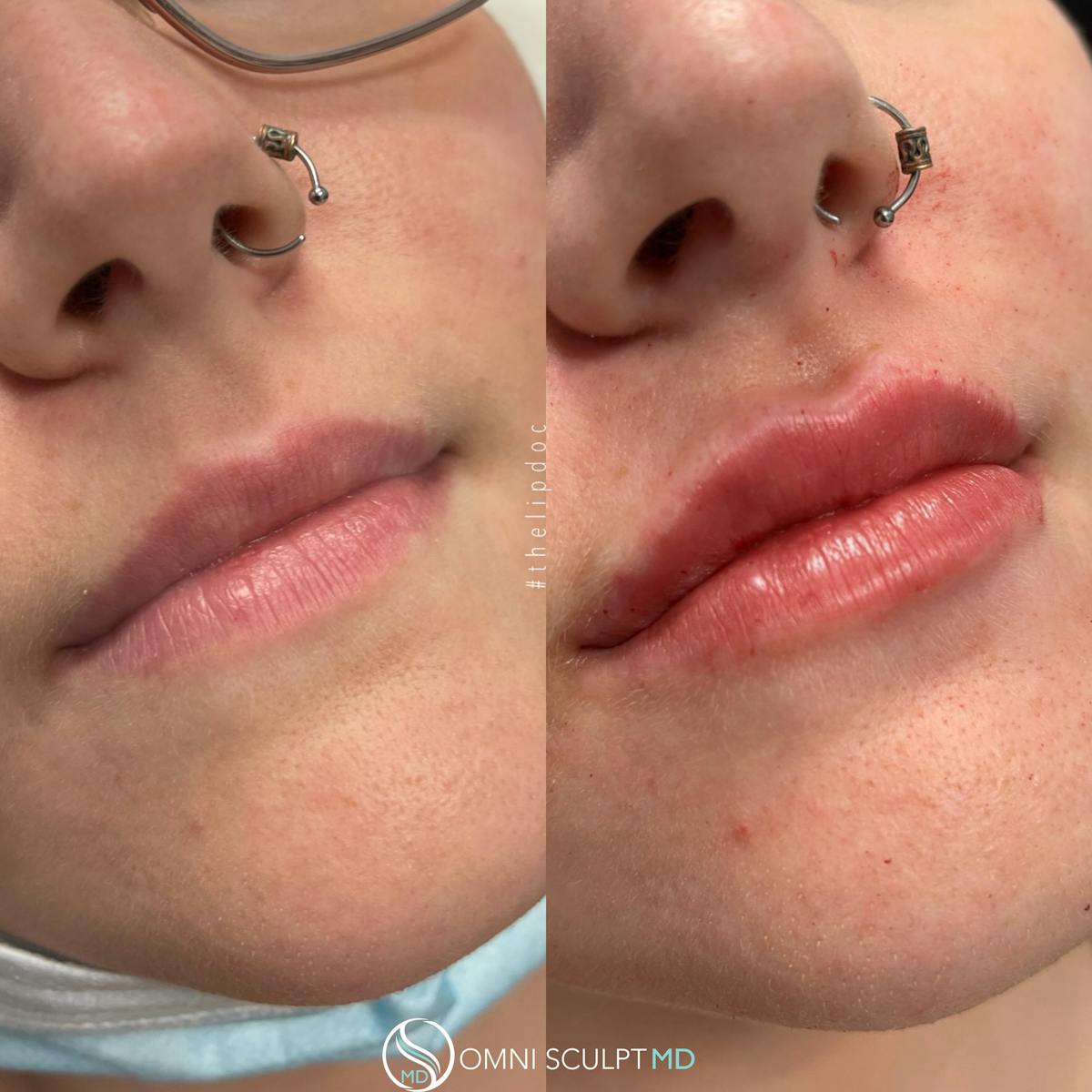 Lips Before & After Gallery - Patient 235036 - Image 2