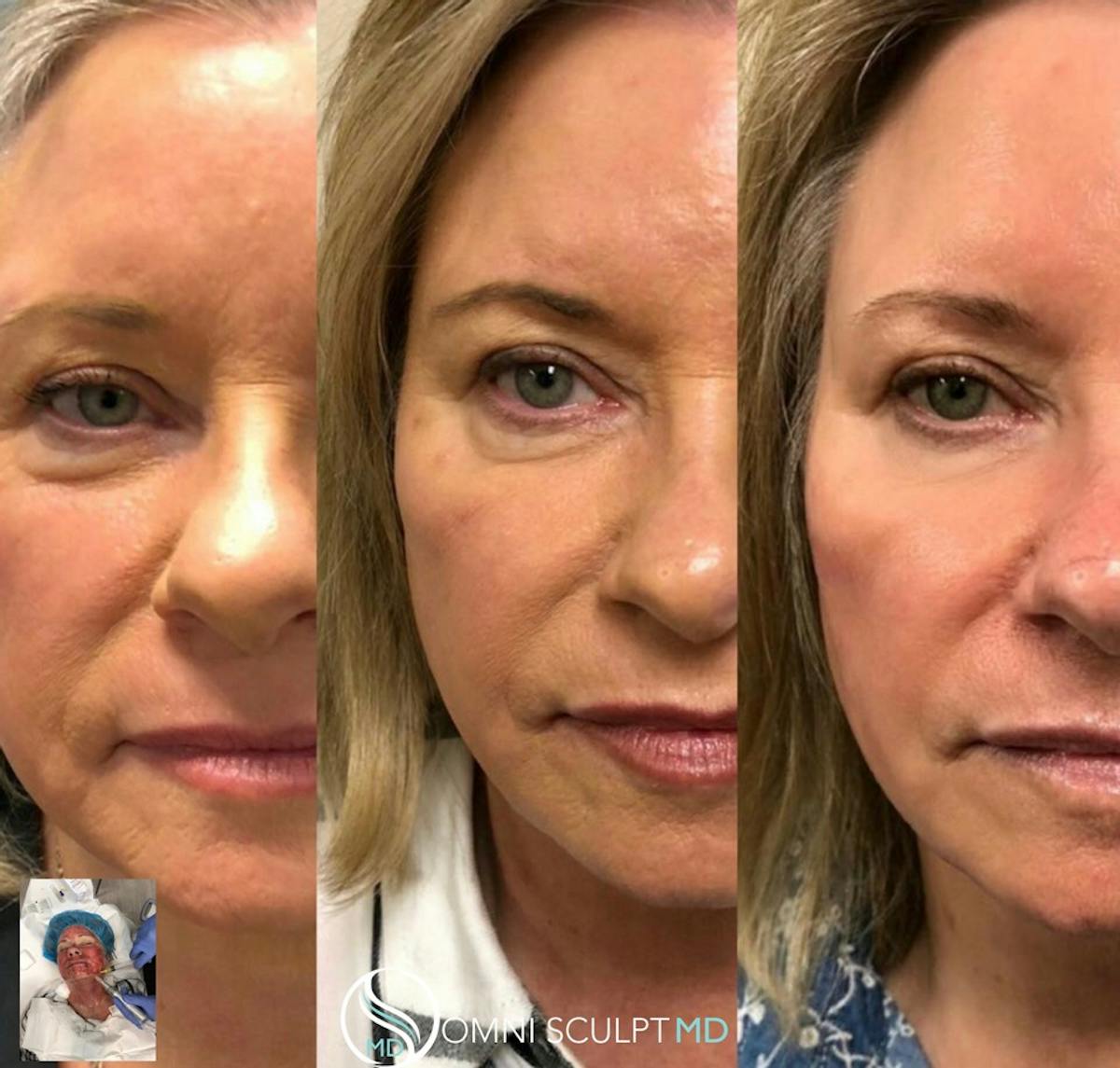 Microneedling Before & After Gallery - Patient 293384 - Image 1