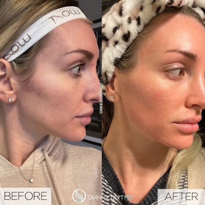 Moxi Laser Before & After Gallery - Patient 373400 - Image 1