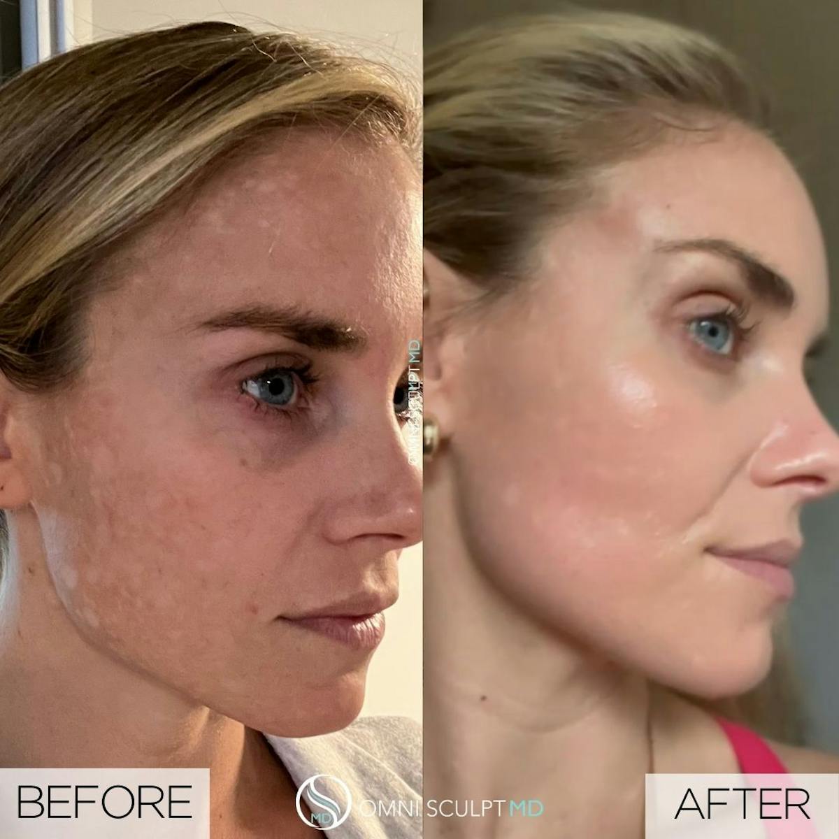 Moxi Laser Before & After Gallery - Patient 216815 - Image 1