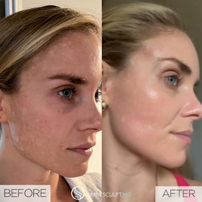 Moxi Laser Before & After Gallery - Patient 216815 - Image 1