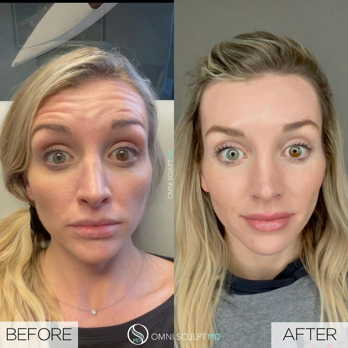 Botox/Neuromodulators Before & After Gallery - Patient 304678 - Image 1