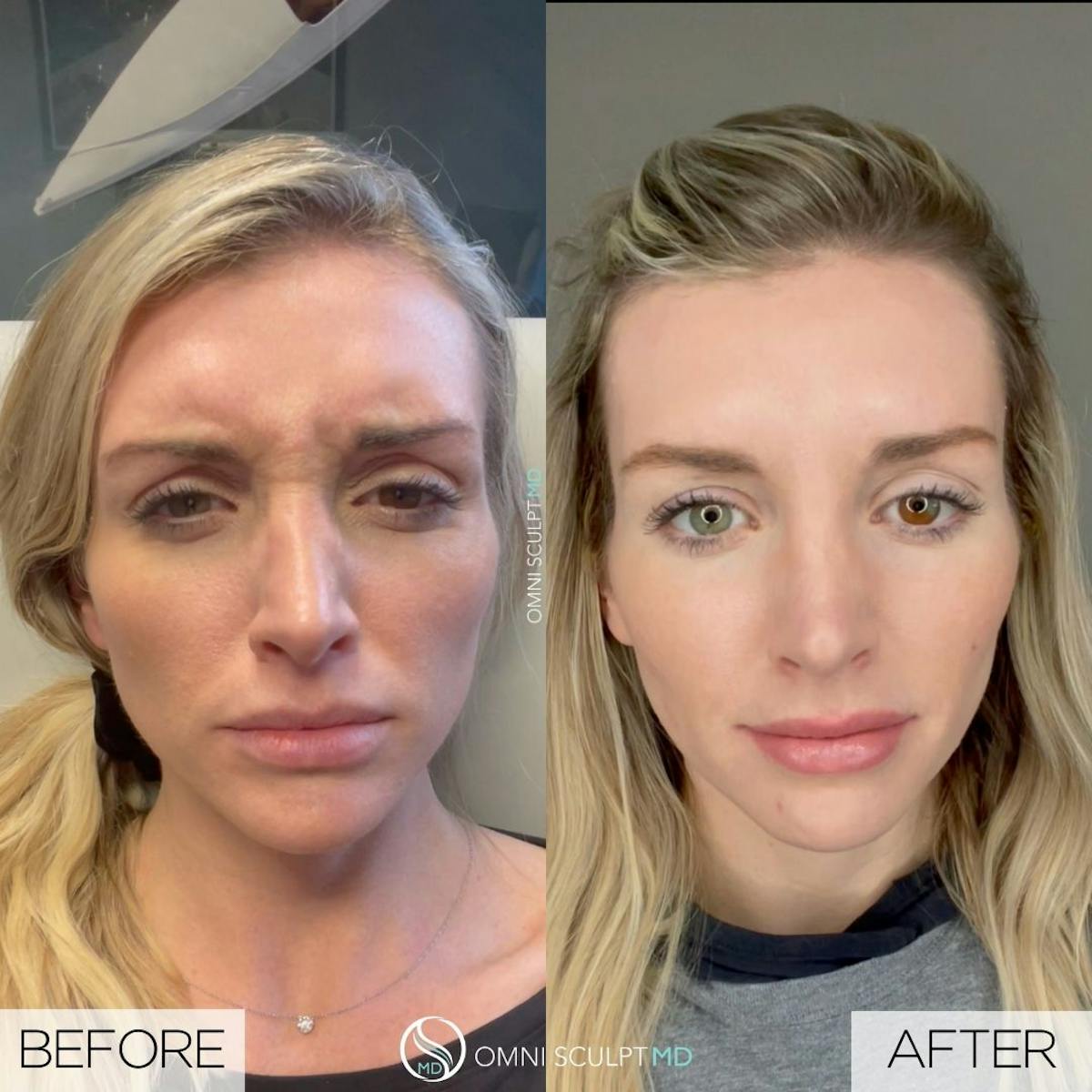 Botox/Neuromodulators Before & After Gallery - Patient 304678 - Image 3