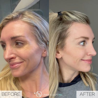 Botox/Neuromodulators Before & After Gallery - Patient 491119 - Image 1