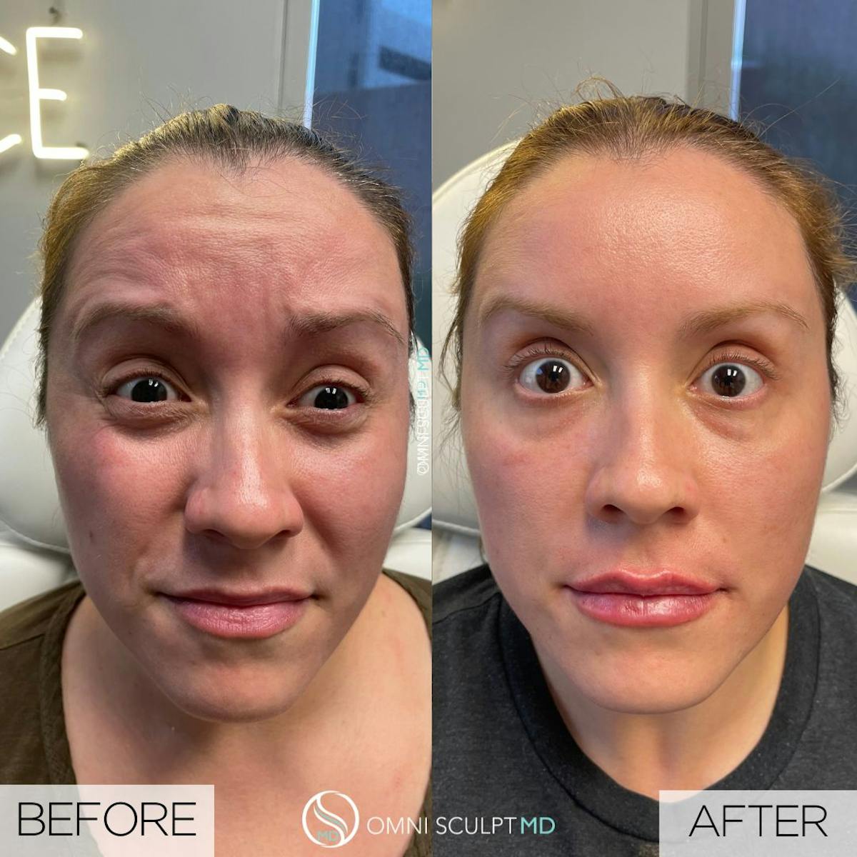 Botox/Neuromodulators Before & After Gallery - Patient 403093 - Image 1