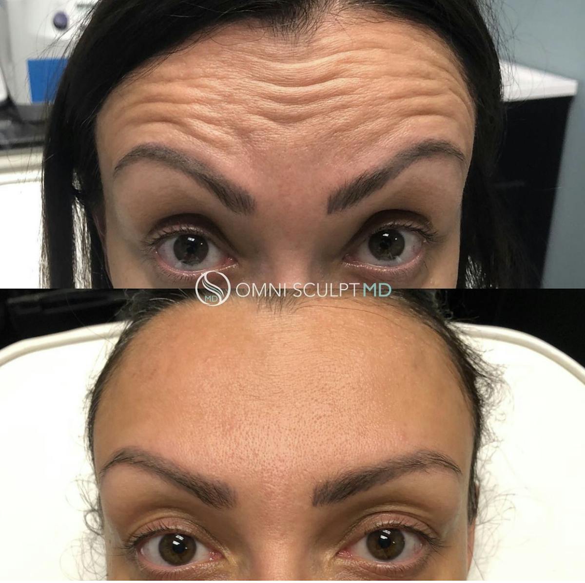 Botox/Neuromodulators Before & After Gallery - Patient 143882 - Image 1