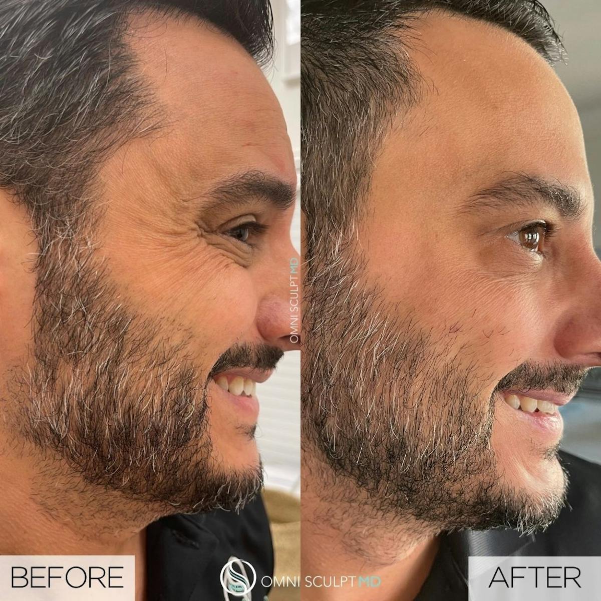 Botox/Neuromodulators Before & After Gallery - Patient 367914 - Image 1