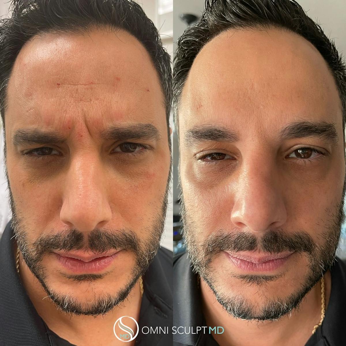 Botox/Neuromodulators Before & After Gallery - Patient 367914 - Image 2