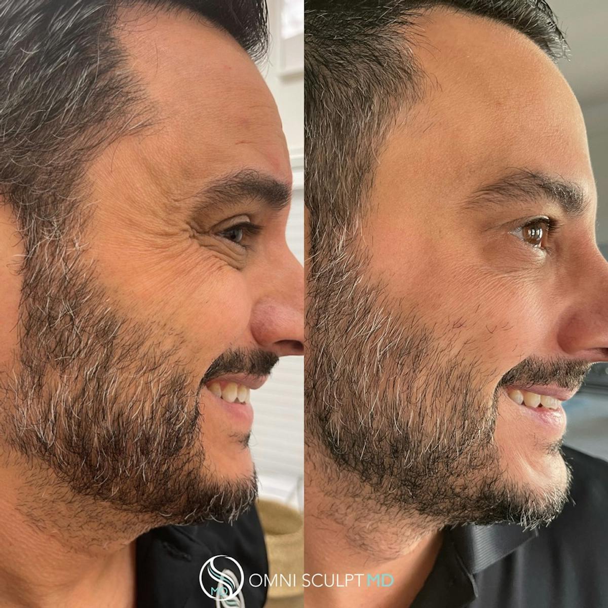 Botox/Neuromodulators Before & After Gallery - Patient 367914 - Image 3