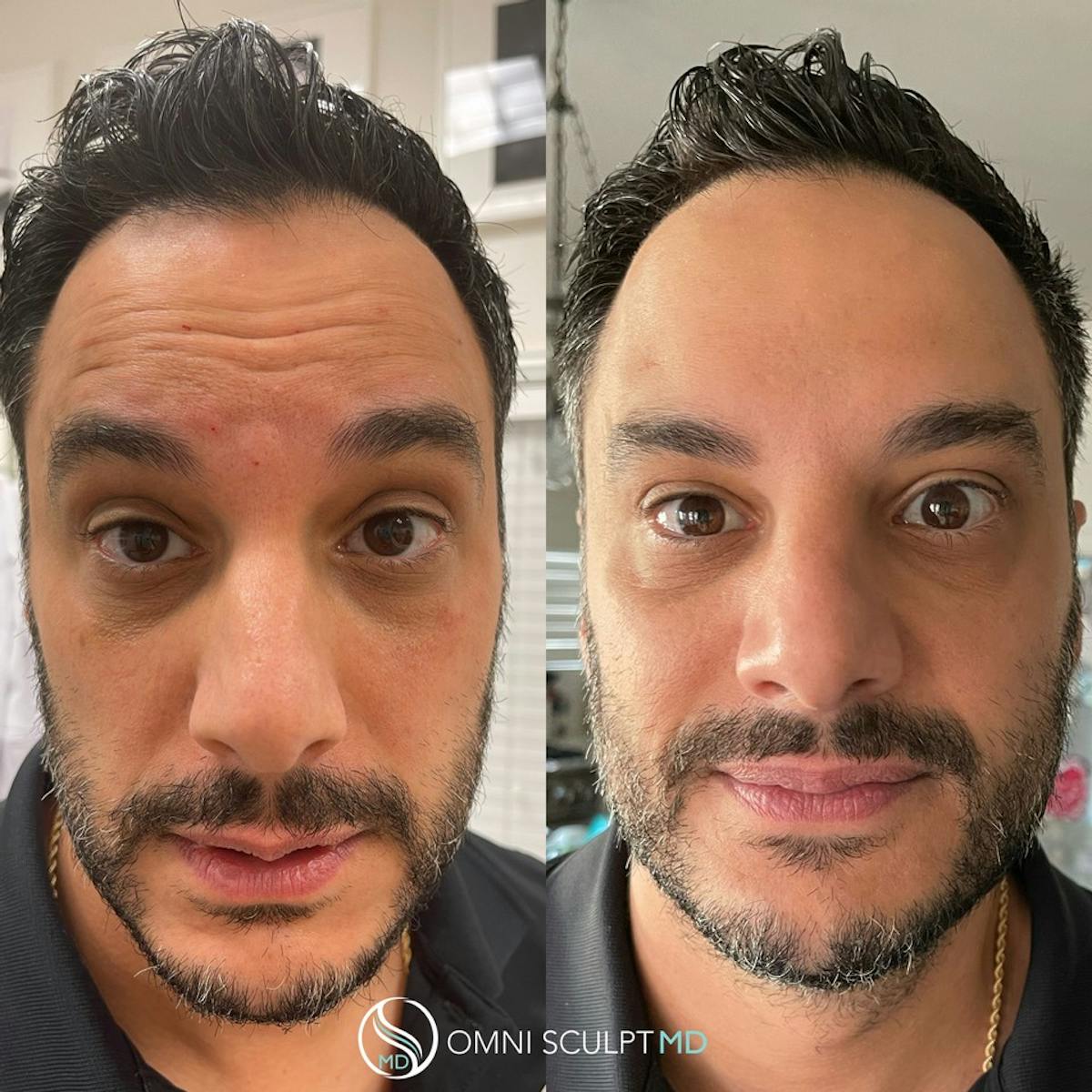 Botox/Neuromodulators Before & After Gallery - Patient 367914 - Image 4