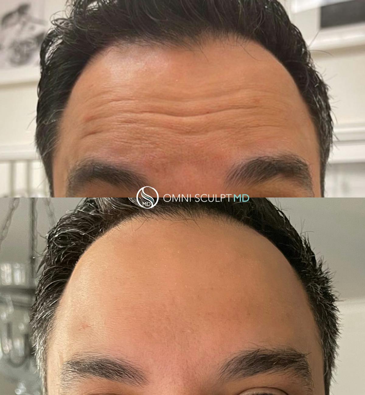 Botox/Neuromodulators Before & After Gallery - Patient 367914 - Image 5