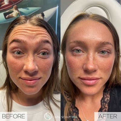 Botox/Neuromodulators Before & After Gallery - Patient 344560 - Image 1