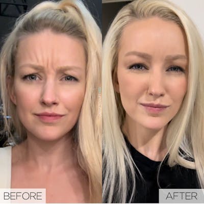 Botox/Neuromodulators Before & After Gallery - Patient 162264 - Image 1