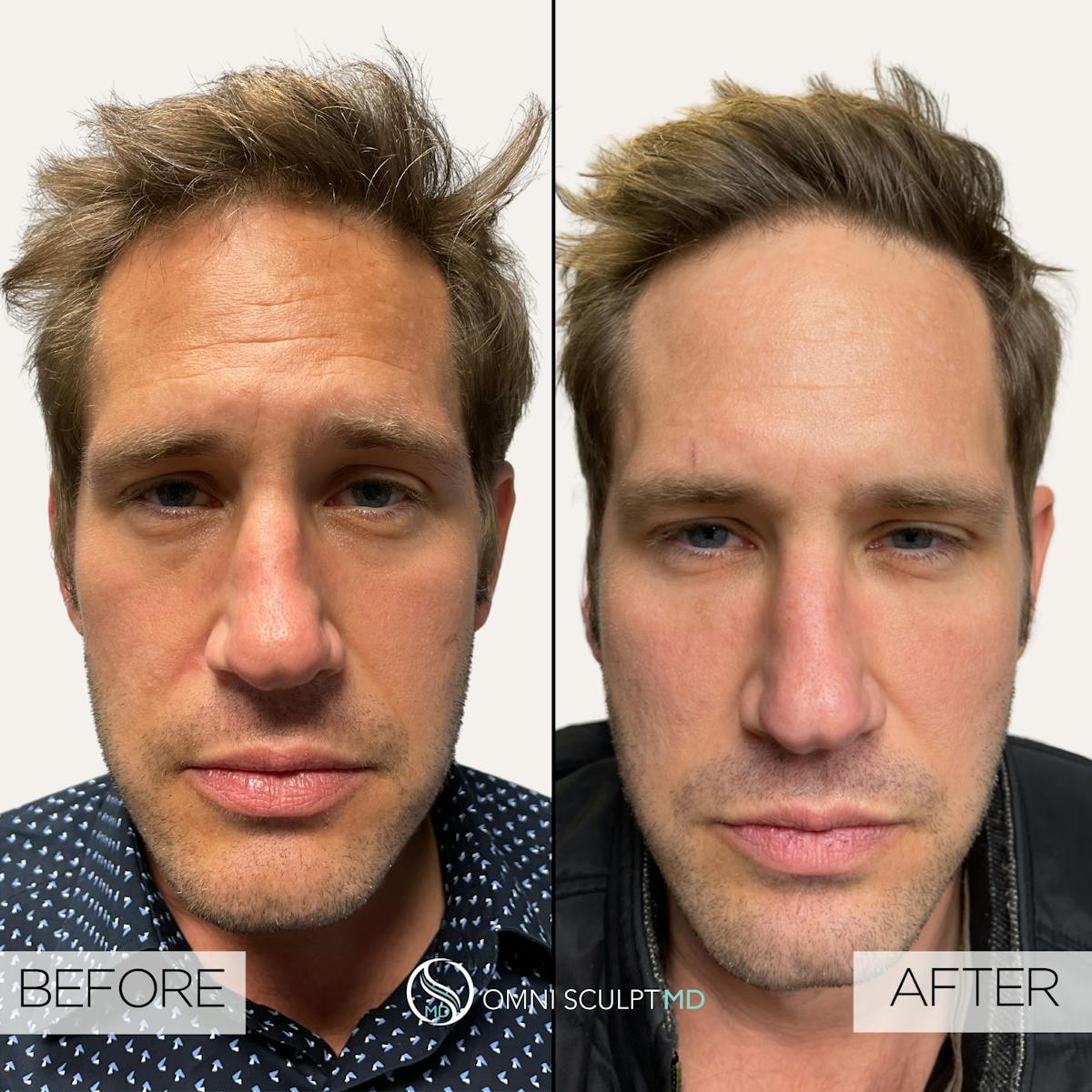 Botox/Neuromodulators Before & After Gallery - Patient 359030 - Image 1
