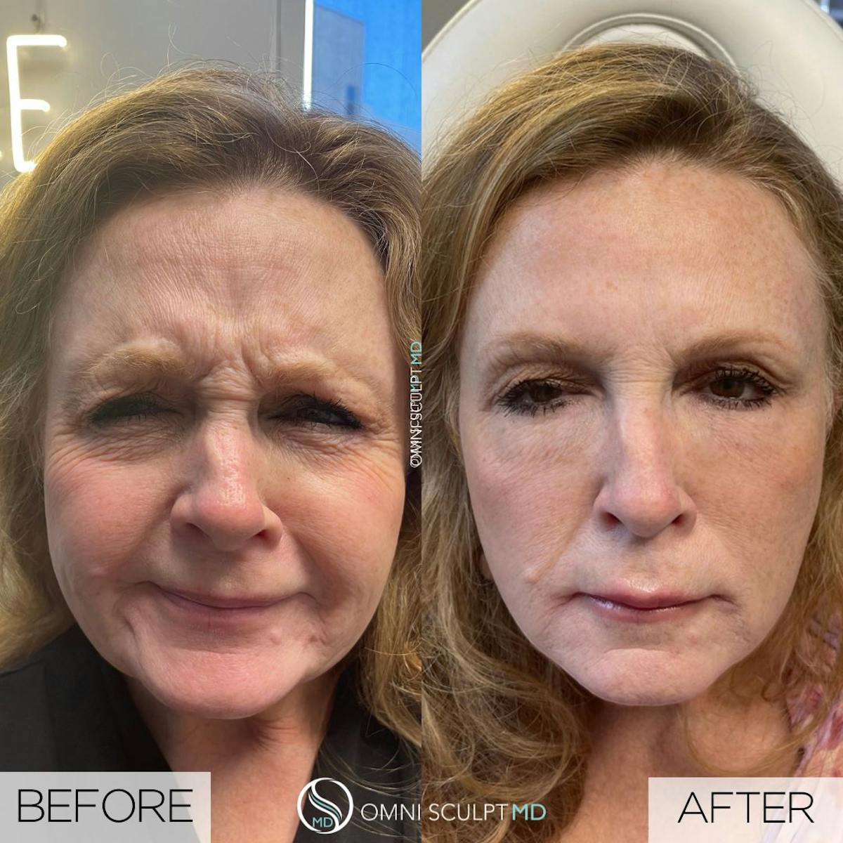 Botox/Neuromodulators Before & After Gallery - Patient 277669 - Image 1