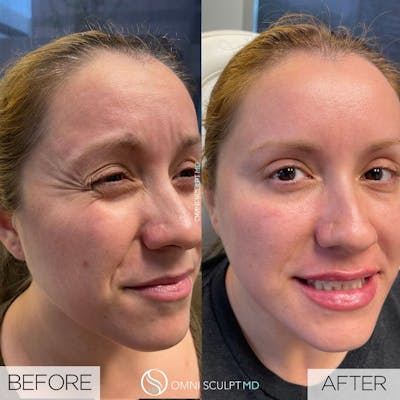 Botox/Neuromodulators Before & After Gallery - Patient 355734 - Image 1