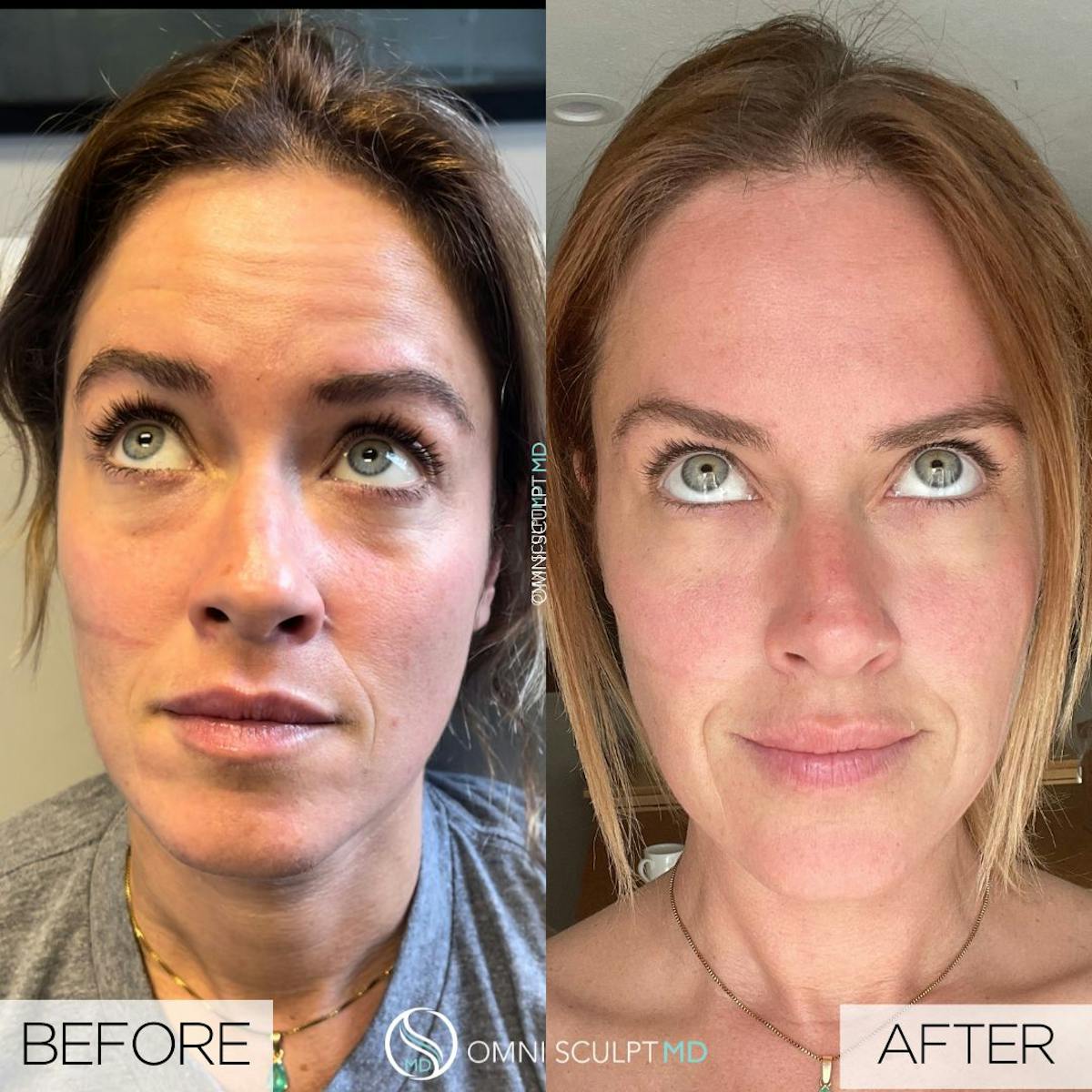 Botox/Neuromodulators Before & After Gallery - Patient 229154 - Image 1
