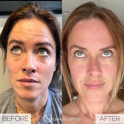 Botox/Neuromodulators Before & After Gallery - Patient 229154 - Image 1