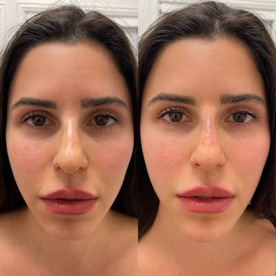 Nose Filler Before & After Gallery - Patient 133900 - Image 1