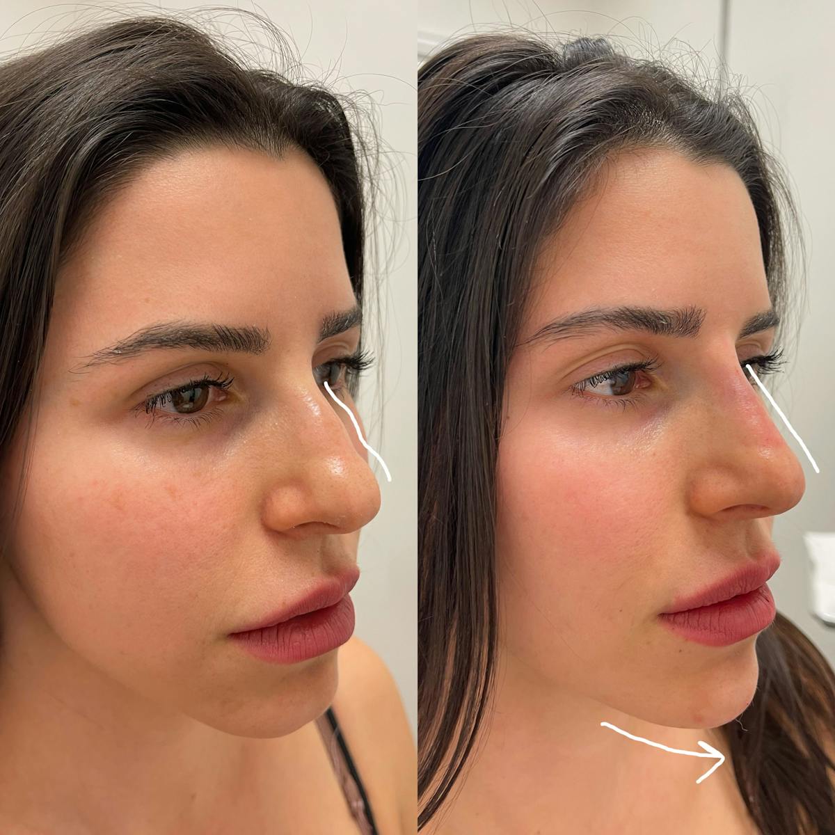 Nose Filler Before & After Gallery - Patient 133900 - Image 2