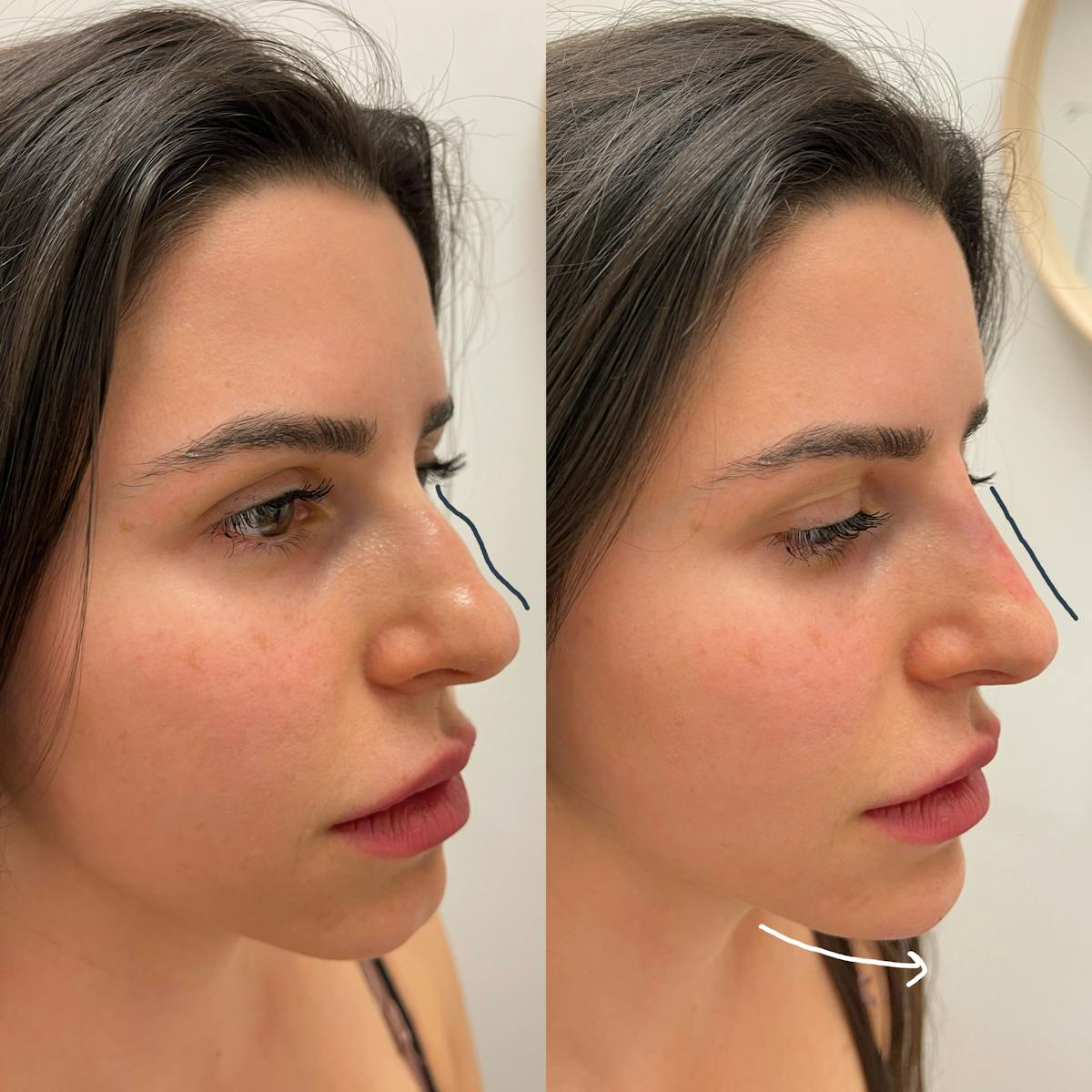 Nose Filler Before & After Gallery - Patient 133900 - Image 3