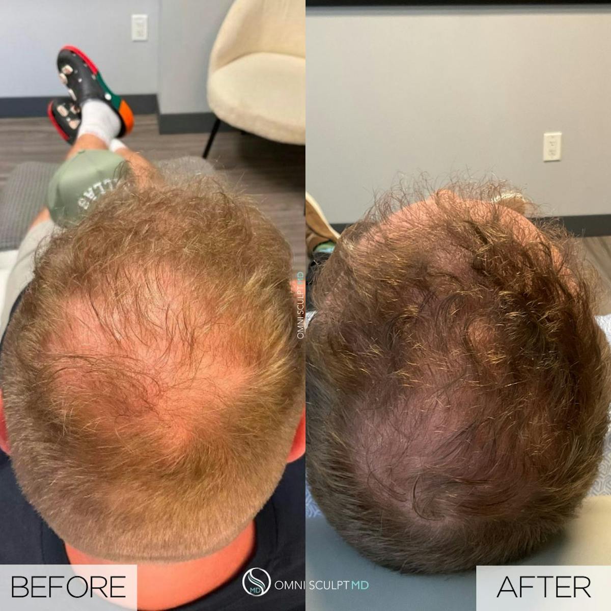 PRF Hair Restoration Before & After Gallery - Patient 316308 - Image 1