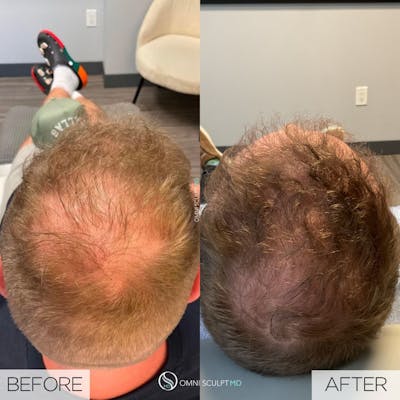 PRF Hair Restoration Before & After Gallery - Patient 316308 - Image 1