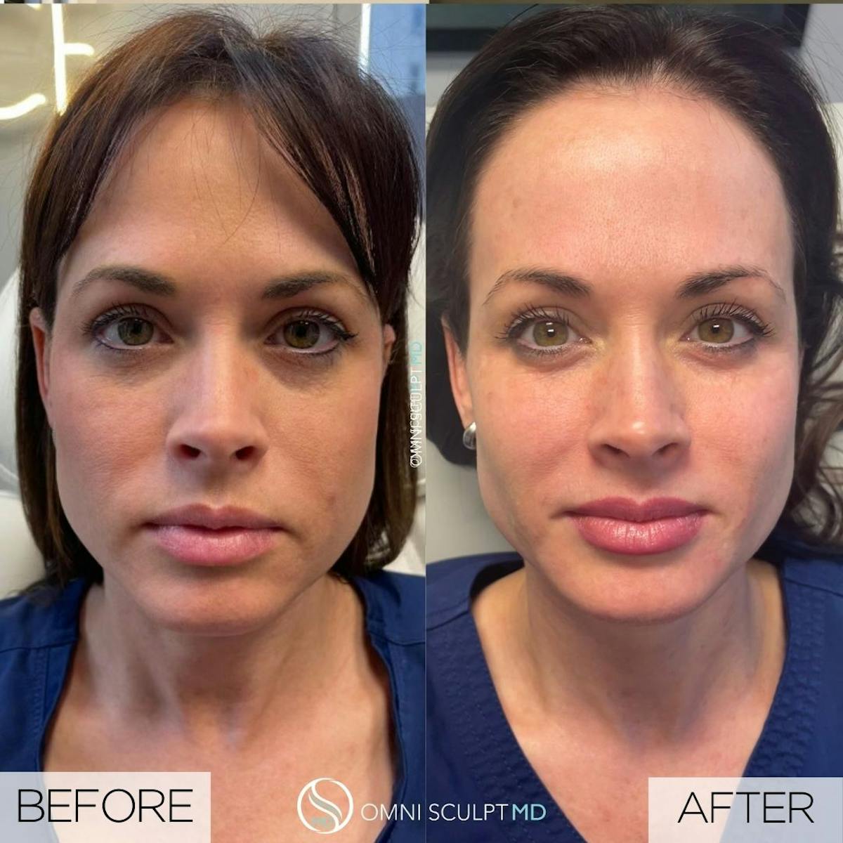 Sculptra Before & After Gallery - Patient 157204 - Image 1