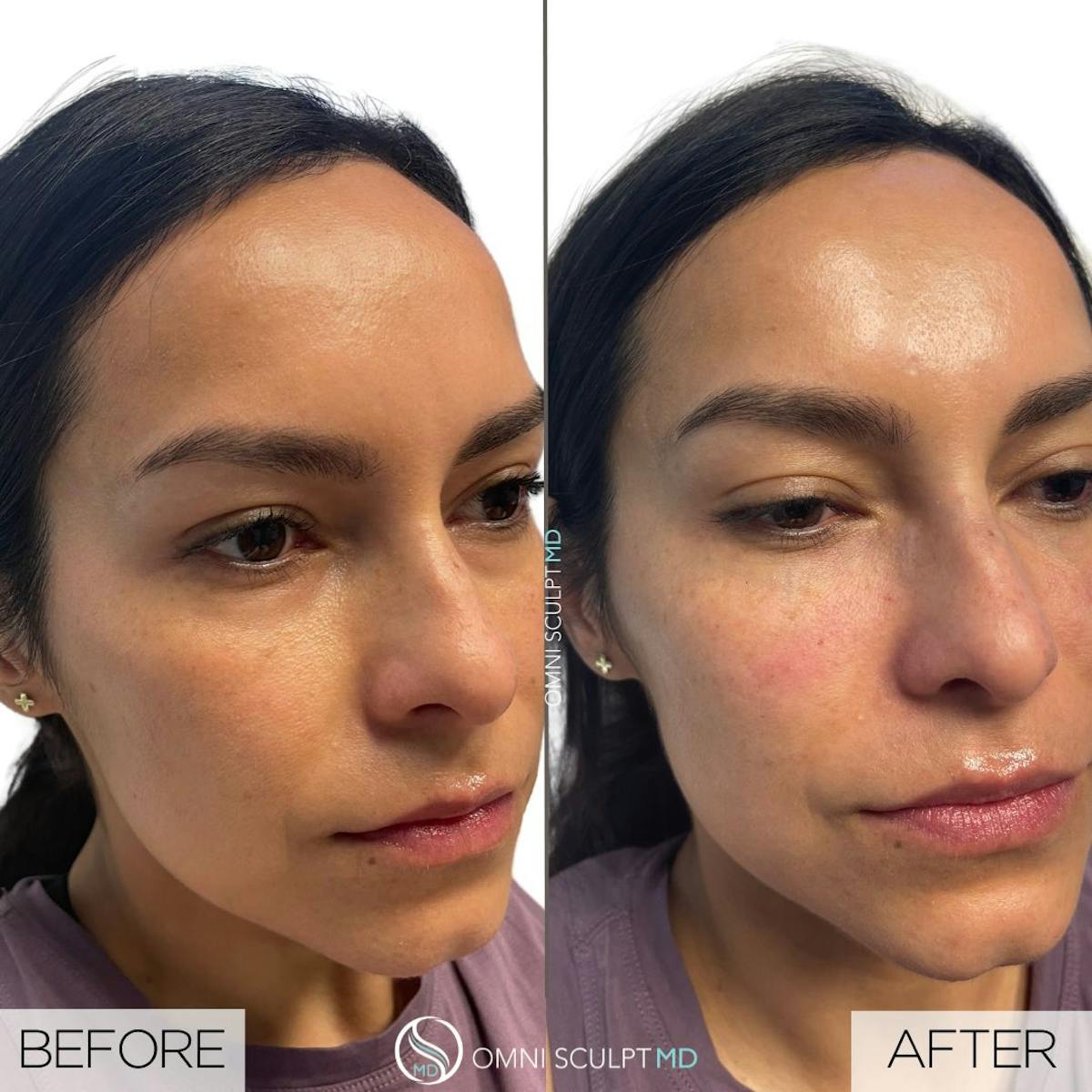Under Eye & Cheeks Before & After Gallery - Patient 718507 - Image 1