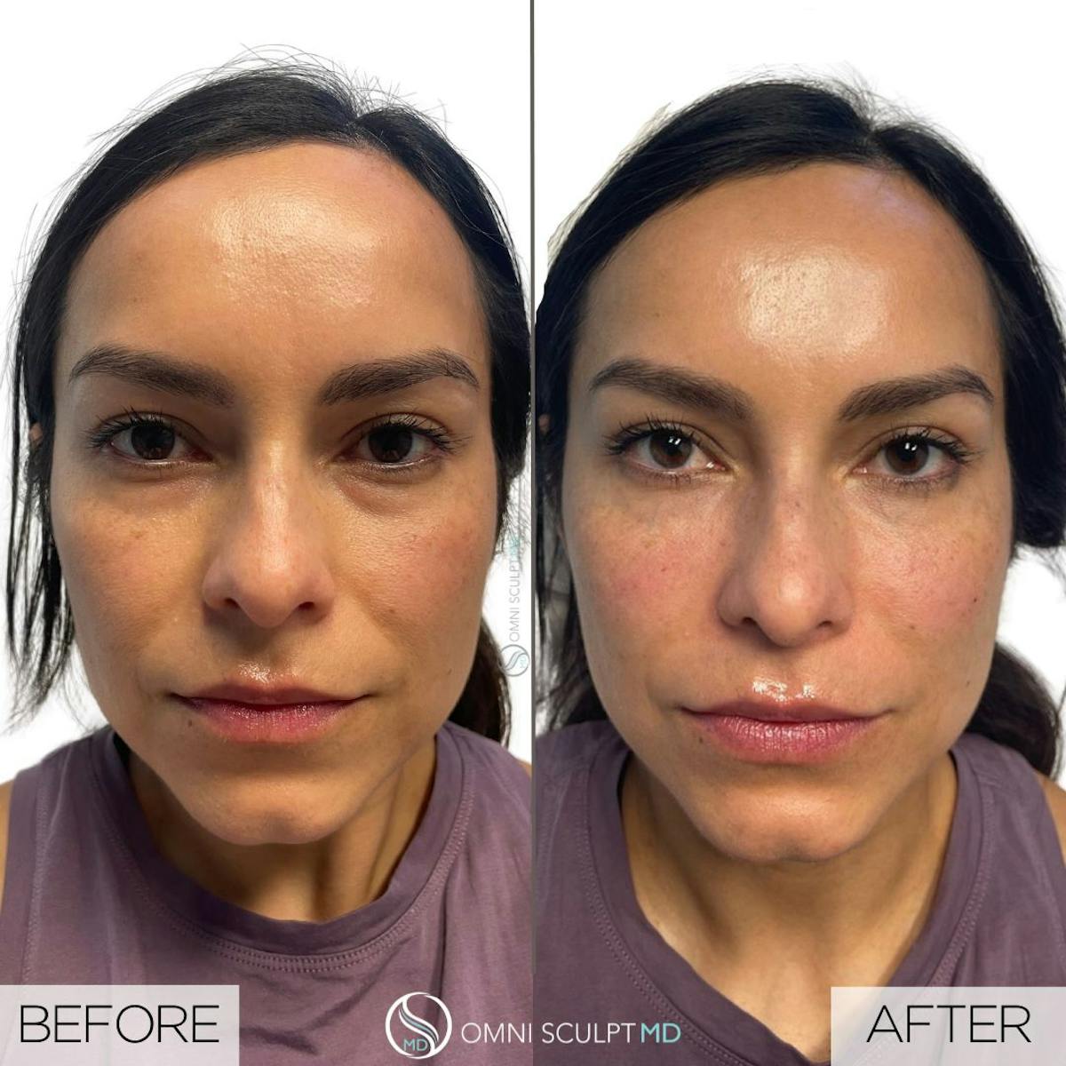 Under Eye & Cheeks Before & After Gallery - Patient 718507 - Image 2