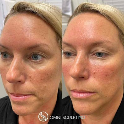 Under Eye & Cheeks Before & After Gallery - Patient 360525 - Image 1
