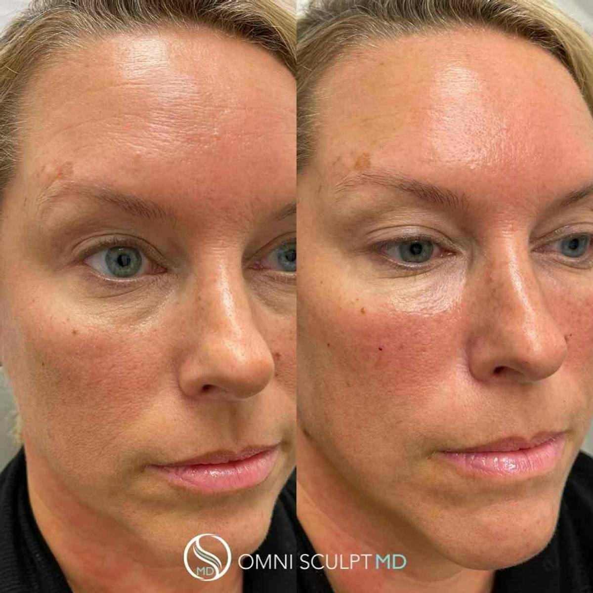Under Eye & Cheeks Before & After Gallery - Patient 360525 - Image 2