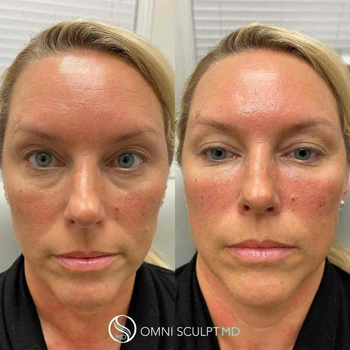 Under Eye & Cheeks Before & After Gallery - Patient 360525 - Image 3