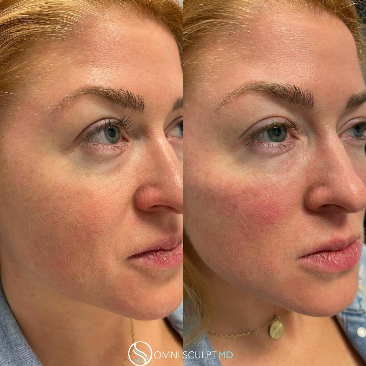 Under Eye & Cheeks Before & After Gallery - Patient 283865 - Image 1