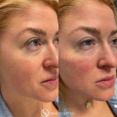 Under Eye & Cheeks Before & After Gallery - Patient 283865 - Image 1