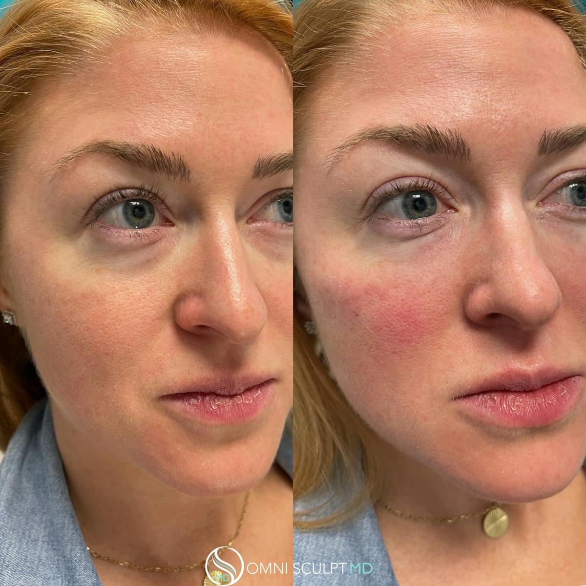Under Eye & Cheeks Before & After Gallery - Patient 283865 - Image 2