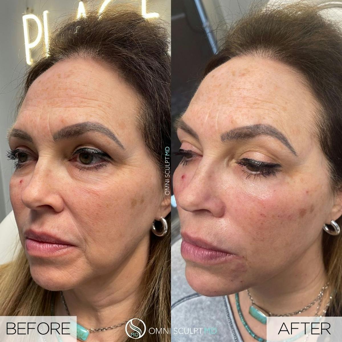 Under Eye & Cheeks Before & After Gallery - Patient 154979 - Image 1