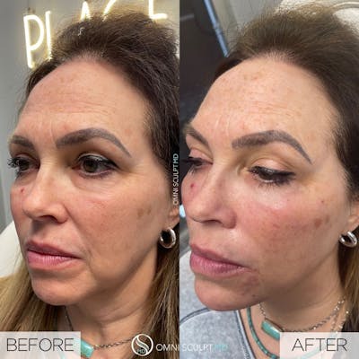 Under Eye & Cheeks Before & After Gallery - Patient 154979 - Image 1