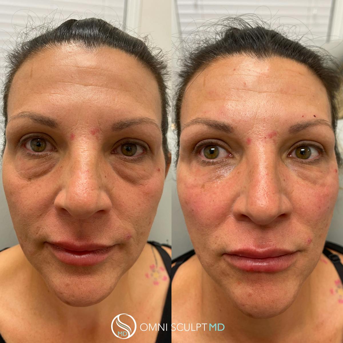 Under Eye & Cheeks Before & After Gallery - Patient 258090 - Image 1