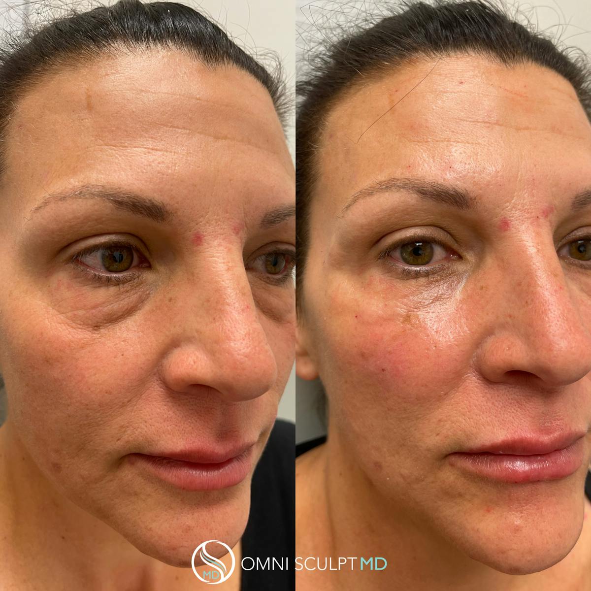 Under Eye & Cheeks Before & After Gallery - Patient 258090 - Image 2