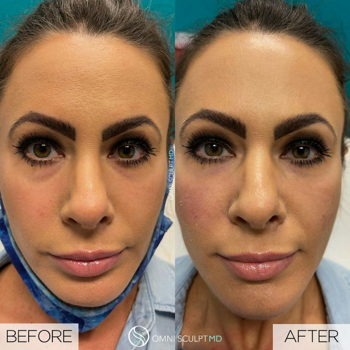 Under Eye & Cheeks Before & After Gallery - Patient 178711 - Image 1