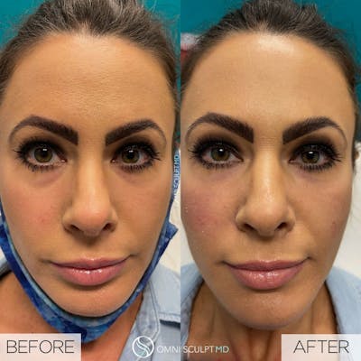 Under Eye & Cheeks Before & After Gallery - Patient 178711 - Image 1