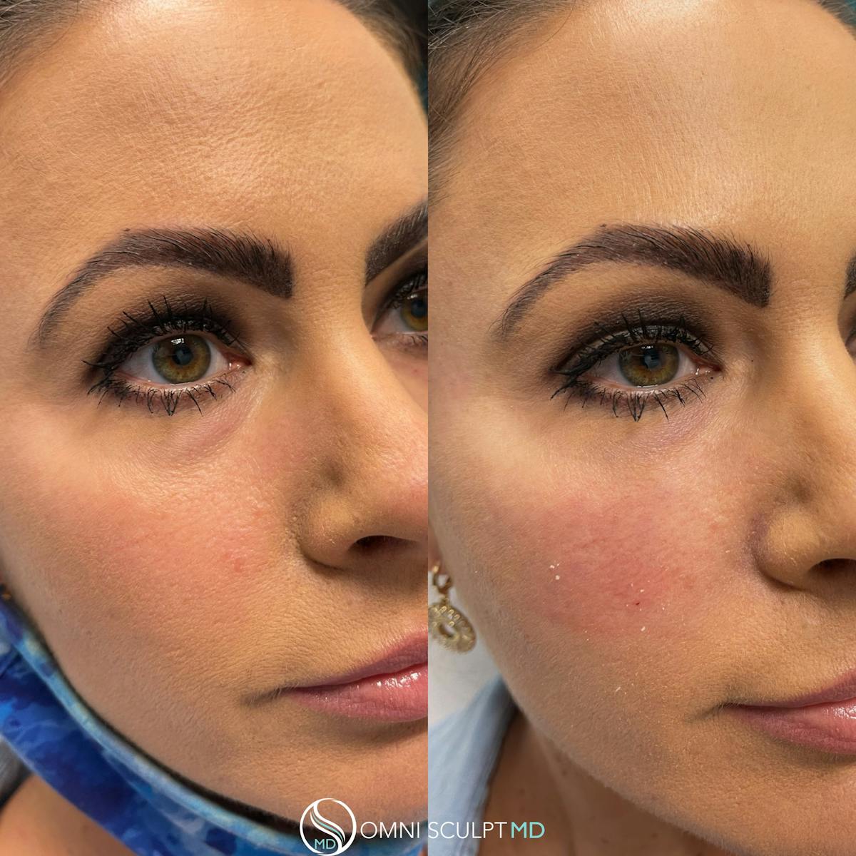 Under Eye & Cheeks Before & After Gallery - Patient 178711 - Image 2
