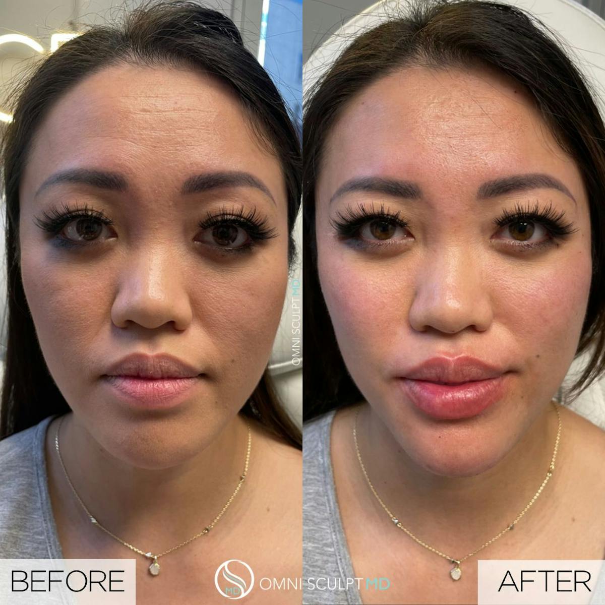 Under Eye & Cheeks Before & After Gallery - Patient 417919 - Image 1