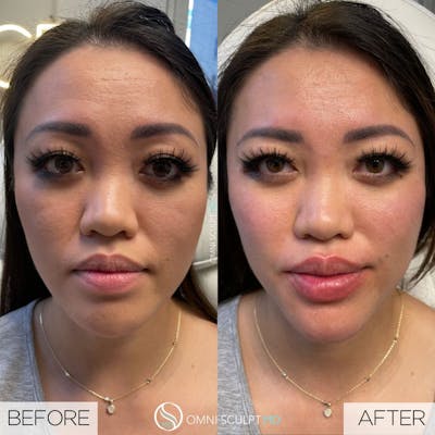 Under Eye & Cheeks Before & After Gallery - Patient 417919 - Image 1