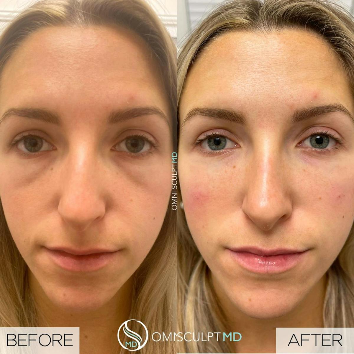 Under Eye & Cheeks Before & After Gallery - Patient 362058 - Image 1