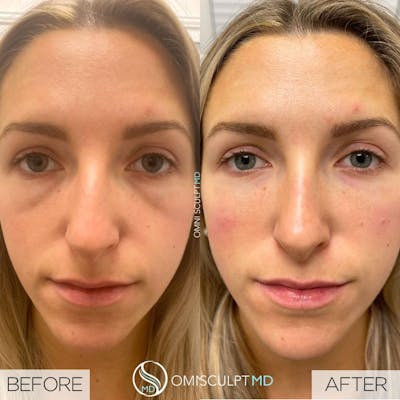 Under Eye & Cheeks Before & After Gallery - Patient 362058 - Image 1