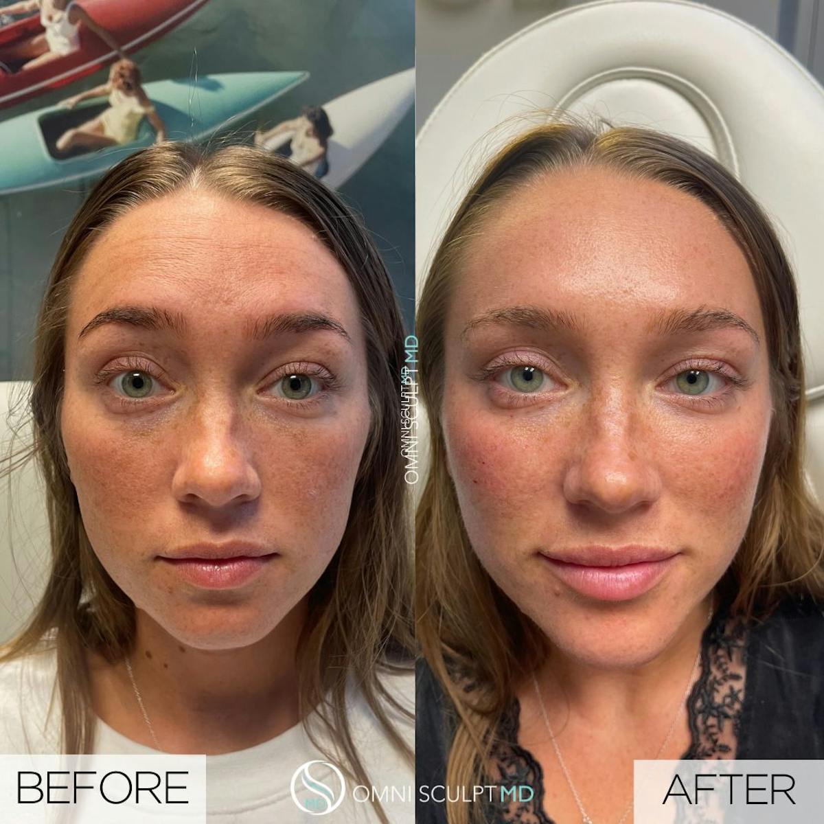 Under Eye & Cheeks Before & After Gallery - Patient 306059 - Image 1
